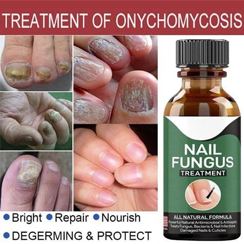 Nail Fungal Treatment