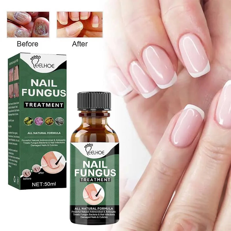 Nail Fungal Treatment