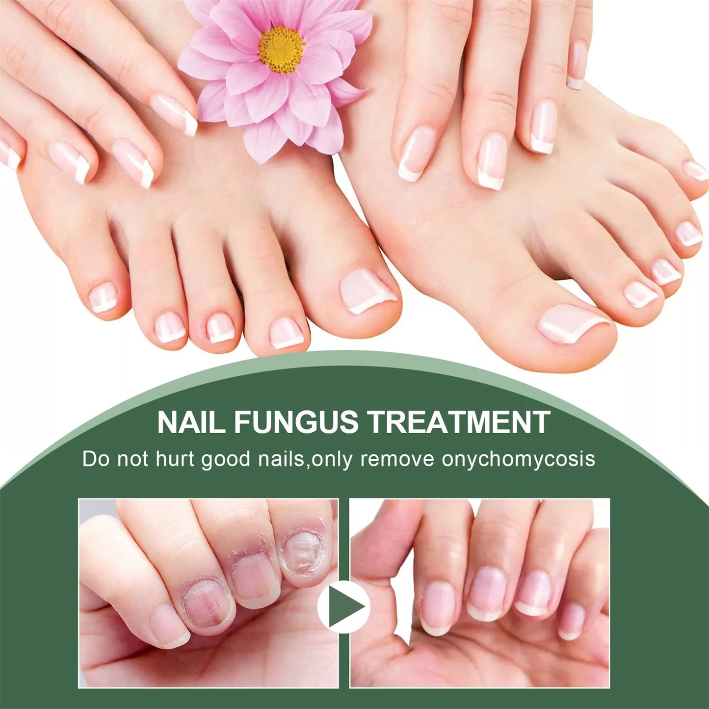 Nail Fungal Treatment