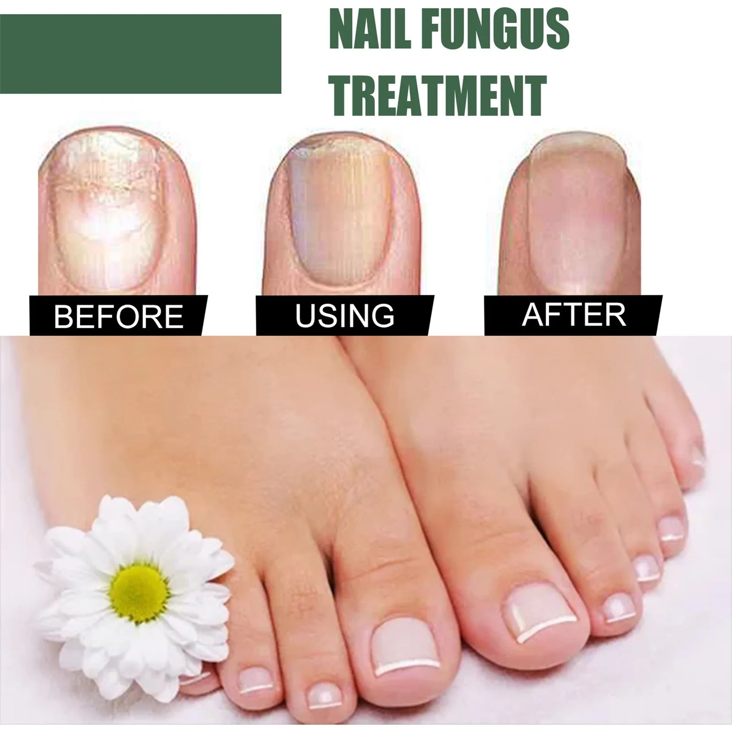 Nail Fungal Treatment