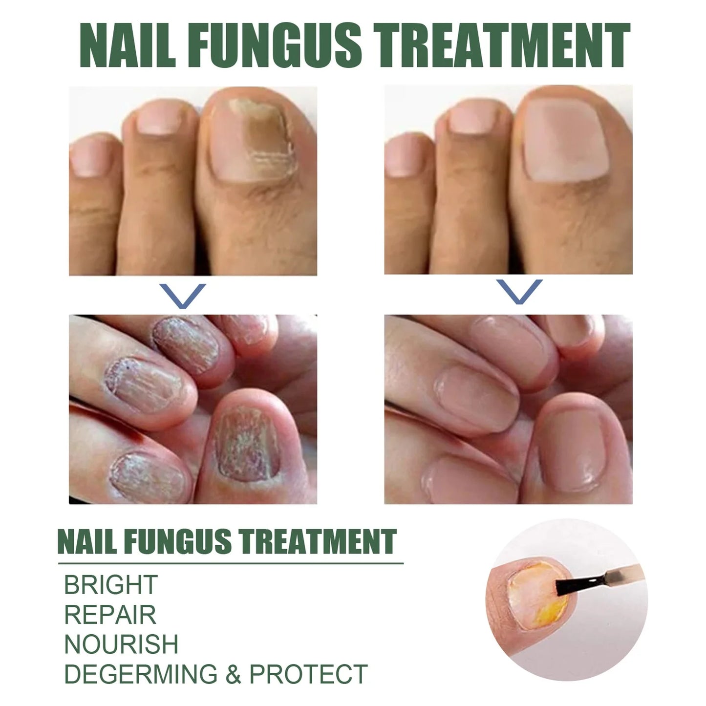 Nail Fungal Treatment