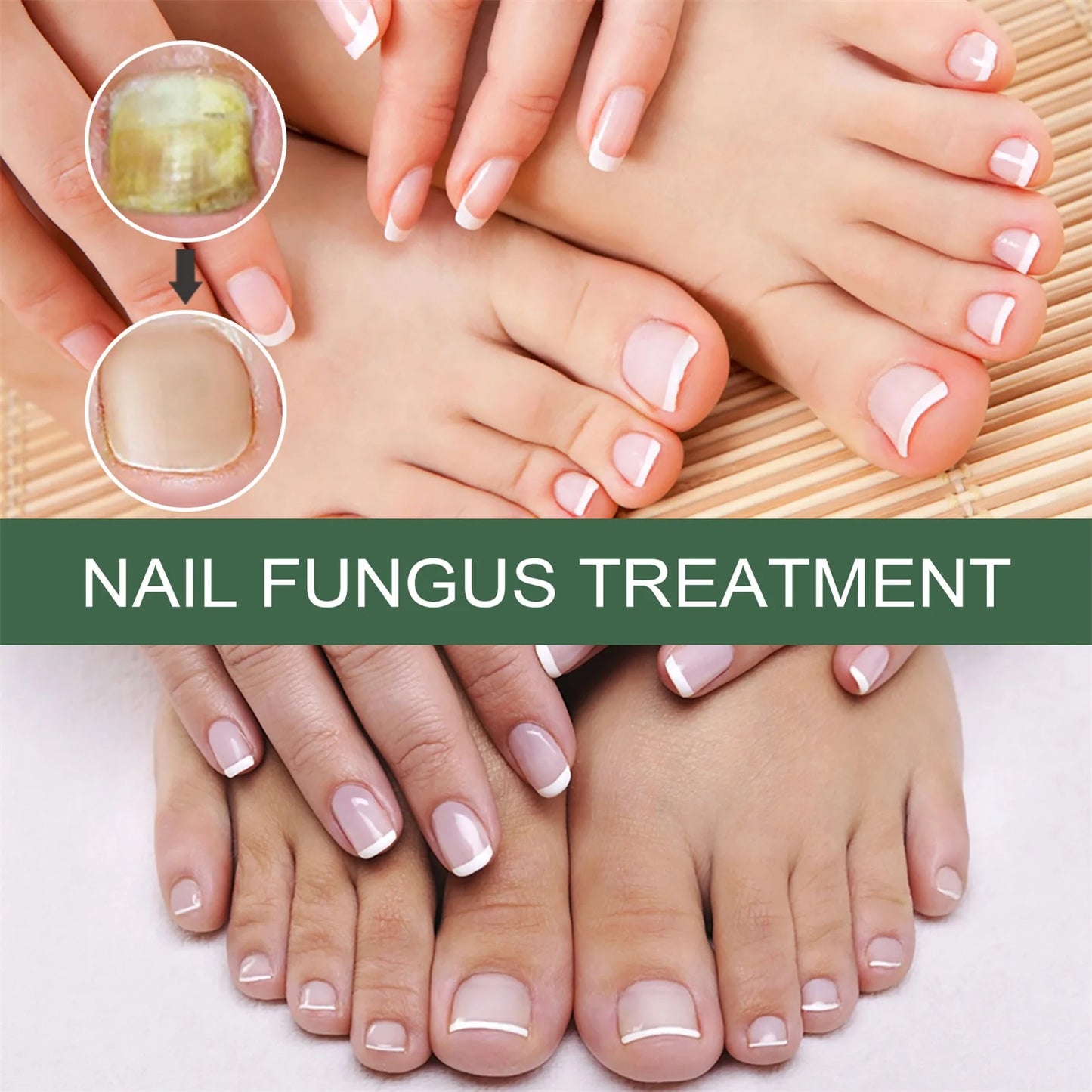 Nail Fungal Treatment