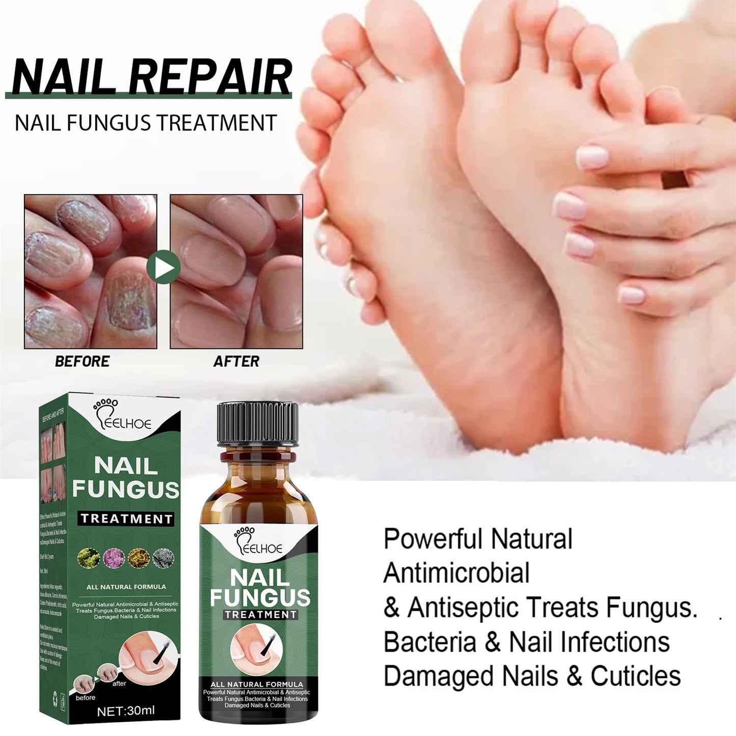 Nail Fungal Treatment