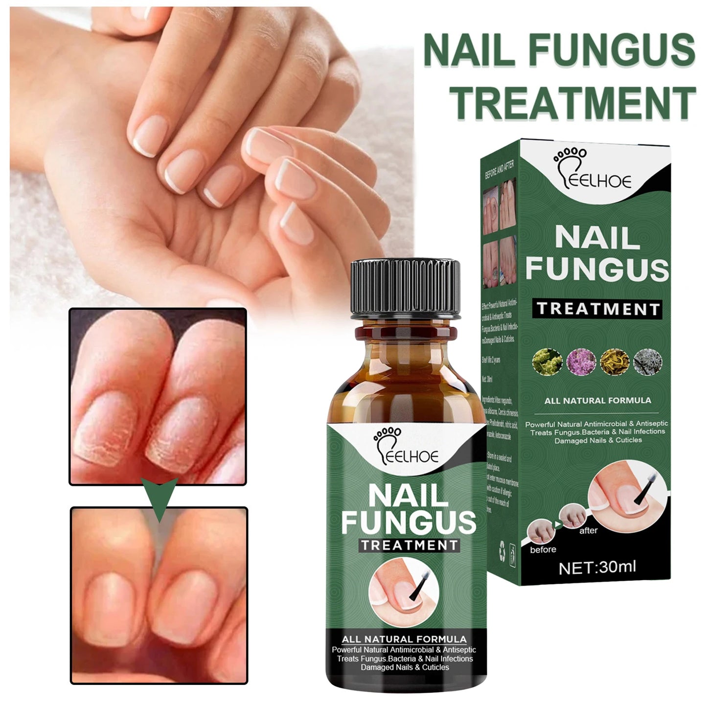 Nail Fungal Treatment