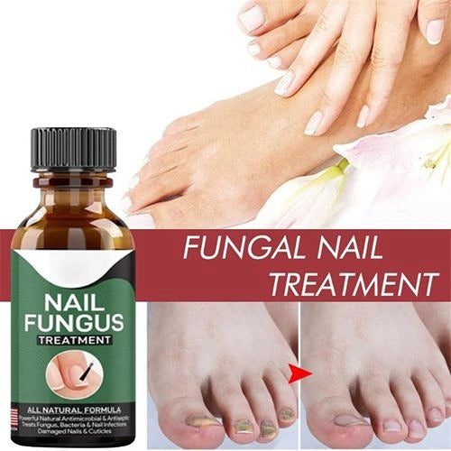 Nail Fungal Treatment